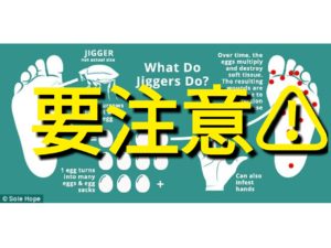 【足に卵が！】アフリカでは要注意、スナノミに寄生された話。